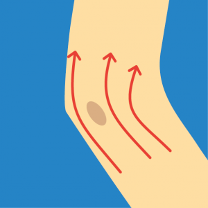 Beispiel für NOVAFON Anwendung bei bursitis2 Beispiel für NOVAFON Anwendung bei bursitis2