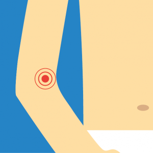 Beispiel für NOVAFON Anwendung bei epicondylitis Beispiel für NOVAFON Anwendung bei epicondylitis