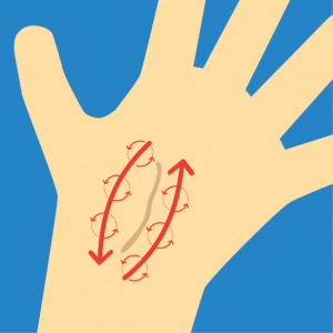 Beispiel für NOVAFON Anwendung bei narbenbehandlung Beispiel für NOVAFON Anwendung bei narbenbehandlung